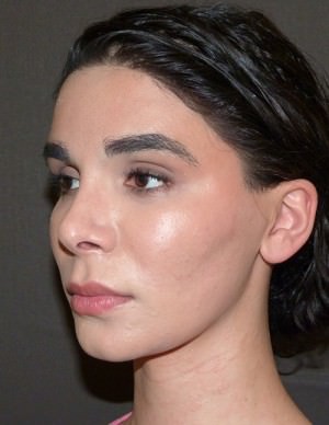 Facial Feminisation Surgery