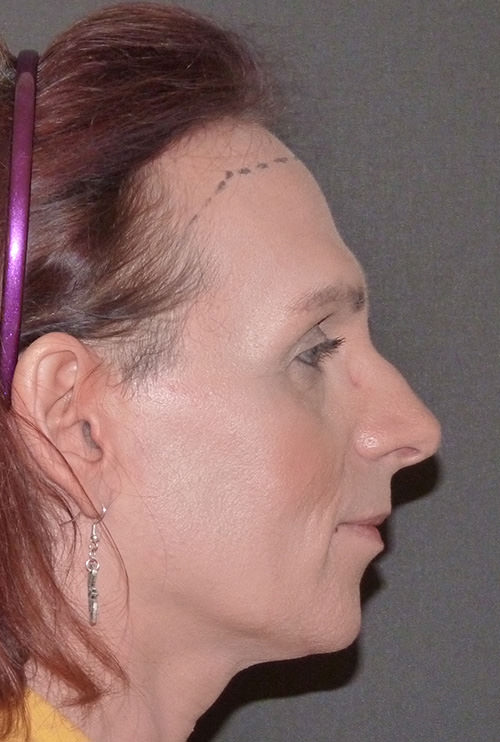 Forehead contouring before and afters by The London Transgender Clinic