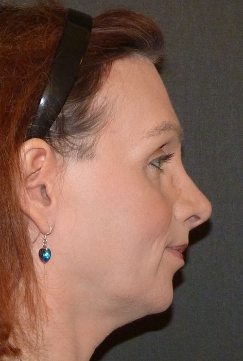 Facial Feminization before and after photo in London by Dr. Inglefield