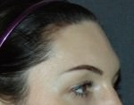 Brow Contouring