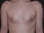 Breast Augmentation