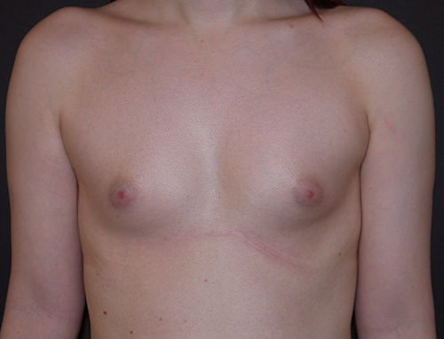 Breast Augmentation