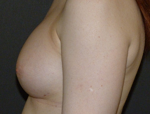 Breast Augmentation