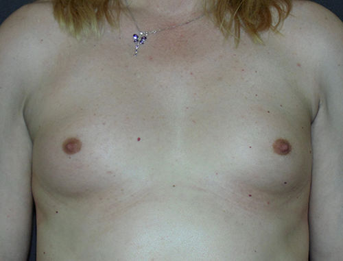 Breast Augmentation