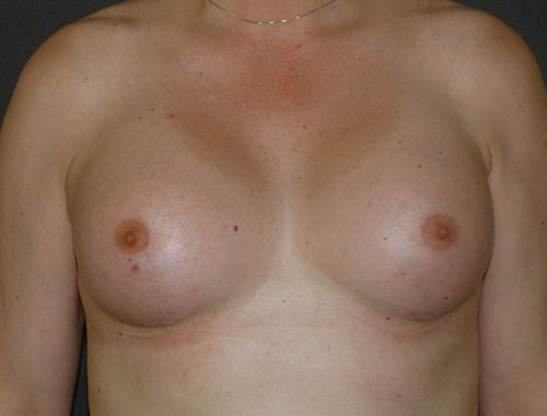 Breast Augmentation