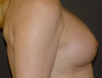 Breast Augmentation