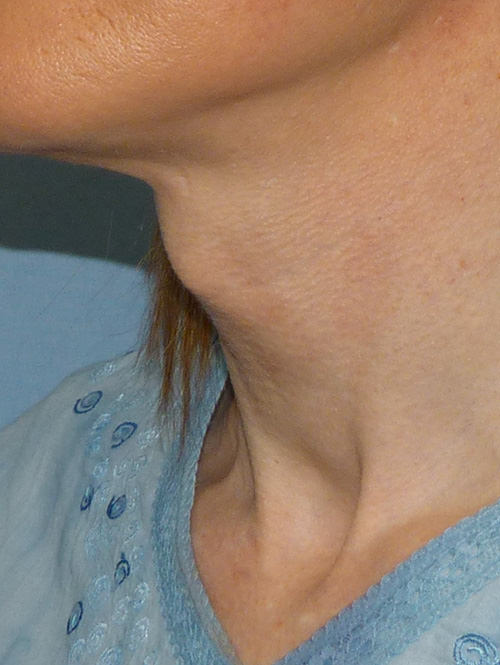 Adams Apple reduction before and afters by The London Transgender Clinic