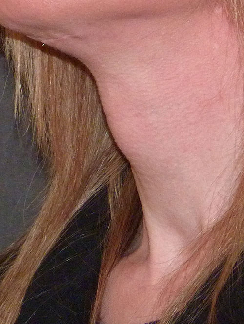 Adams Apple reduction before and afters by The London Transgender Clinic