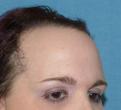Hairline Lowering before and after photo by The London Transgender Clinic