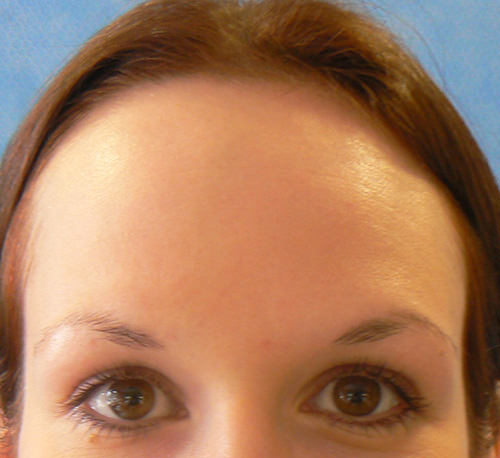 Hairline Lowering before and after photo by The London Transgender Clinic