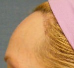 Hair Line Lowering