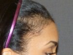 Hair Line Lowering