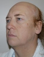 Facial Feminisation Surgery
