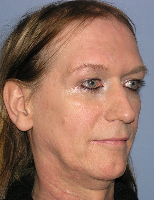 Facial Feminisation Surgery