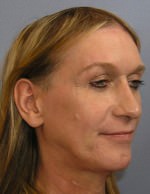 Facial Feminisation Surgery