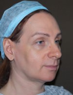 Facial Feminisation Surgery