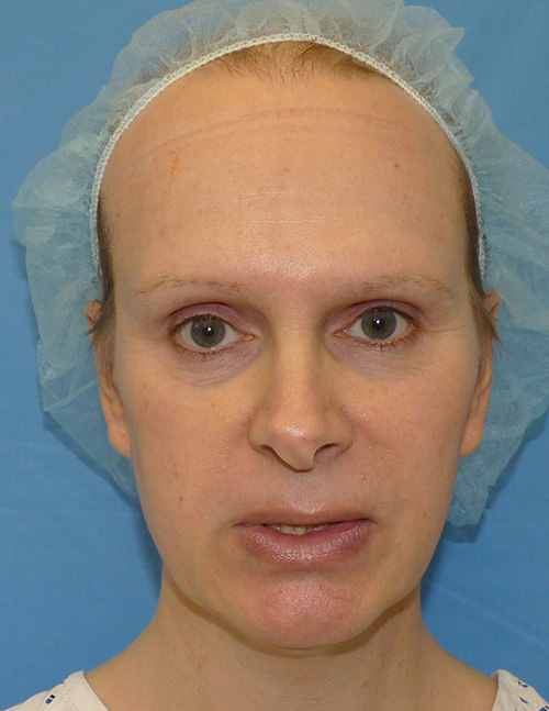 Facial Feminisation Surgery