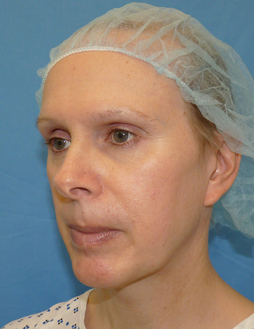 Facial Feminisation Surgery