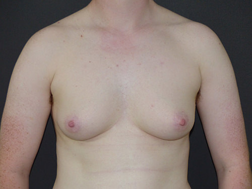 FtM Top Surgery