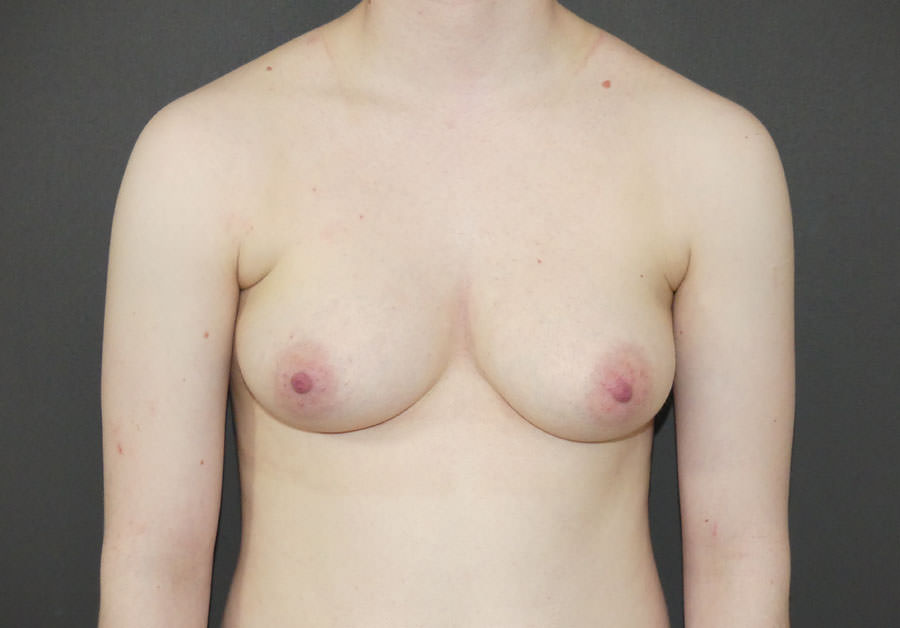FtM Top Surgery