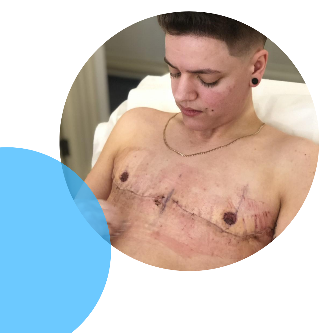 What I wish knew before... Top Surgery! - Inglefield, Christopher (thelondontransgenderclinic.uk)