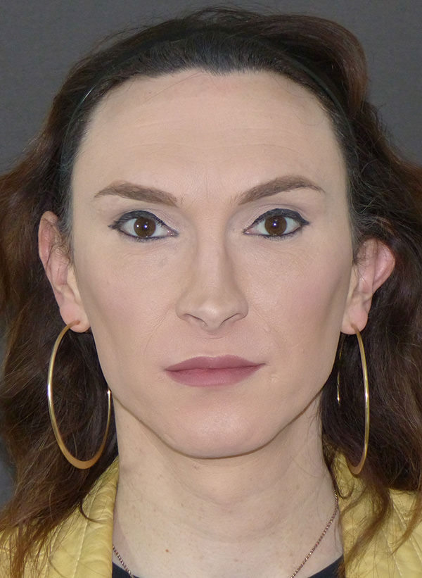 Facial Feminization before and after photo in London by Dr. Inglefield