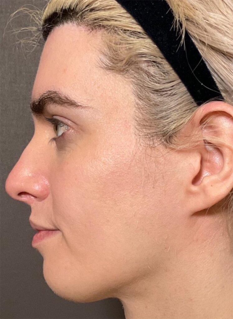 Septo-Rhinoplasty