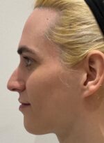 Septo-Rhinoplasty