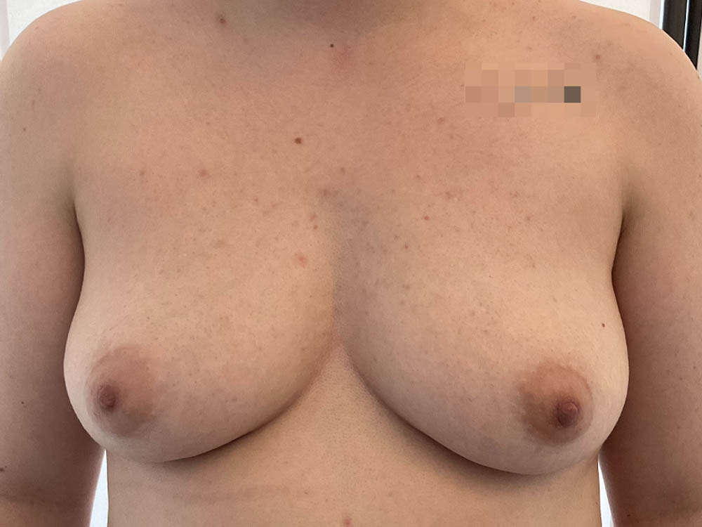 FtM Top Surgery