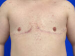 FtM Top Surgery