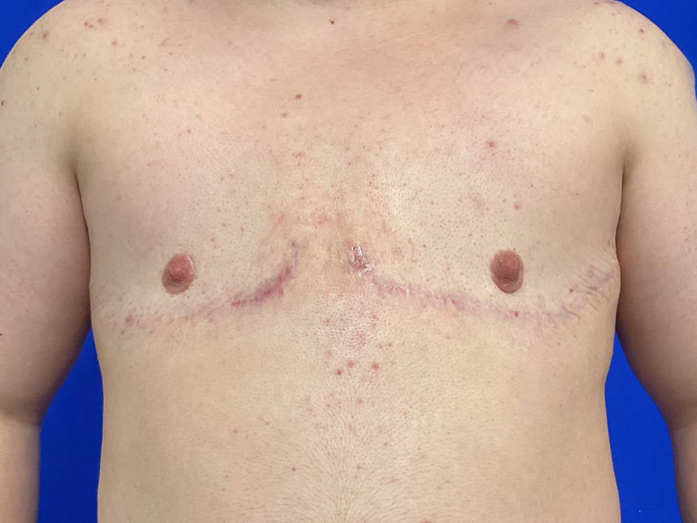 FtM Top Surgery