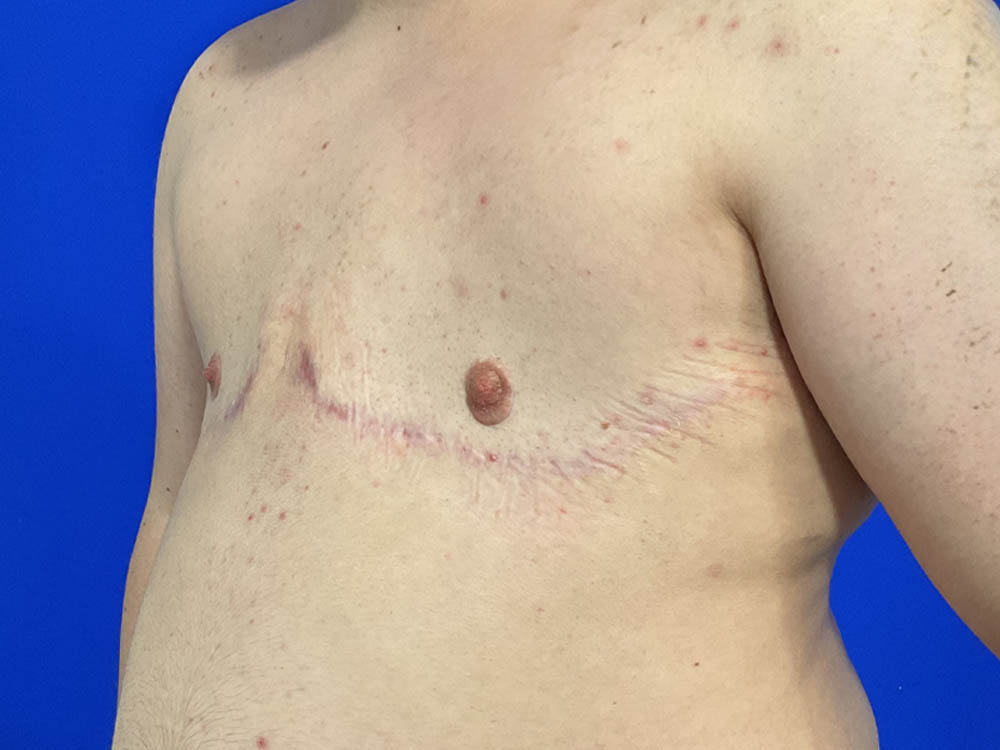 FtM Top Surgery