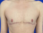 FtM Top Surgery