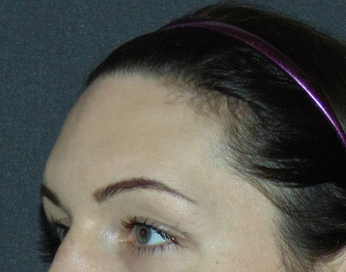 Brow Contouring