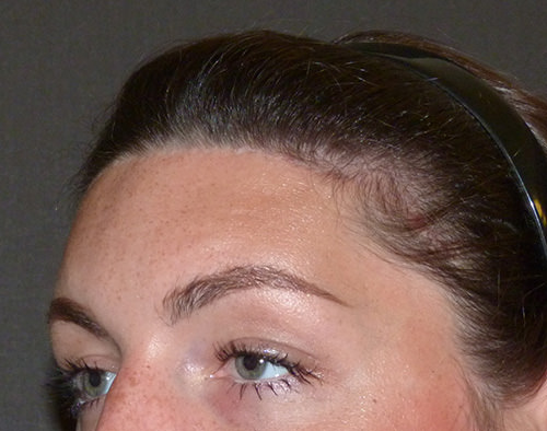 Brow Contouring
