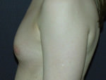 Breast Augmentation