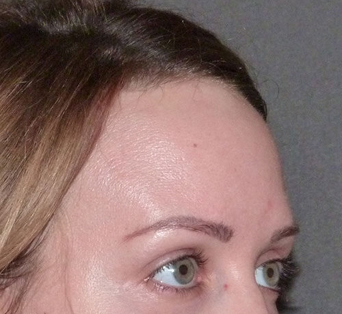 Hair Line Lowering
