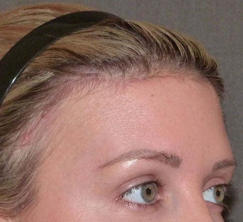 Hair Line Lowering