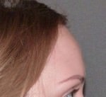 Hair Line Lowering