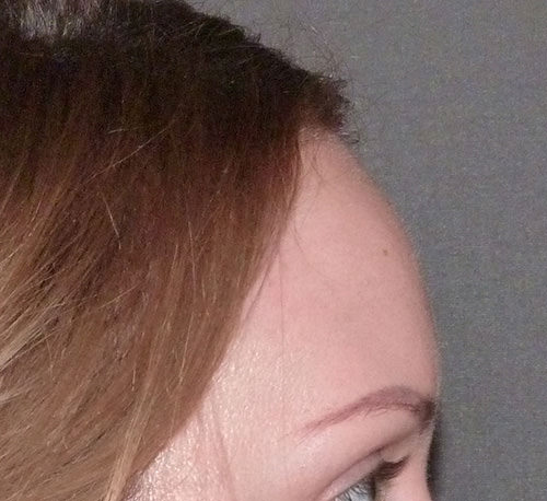 Hair Line Lowering