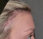 Hair Line Lowering