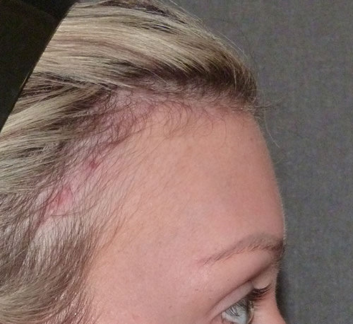 Hair Line Lowering