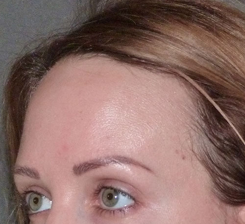 Hair Line Lowering
