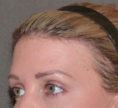 Hair Line Lowering