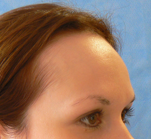 Hair Line Lowering
