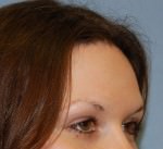 Hair Line Lowering