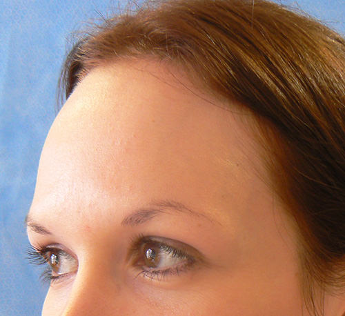 Hair Line Lowering