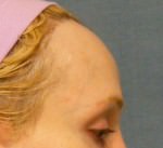 Hair Line Lowering