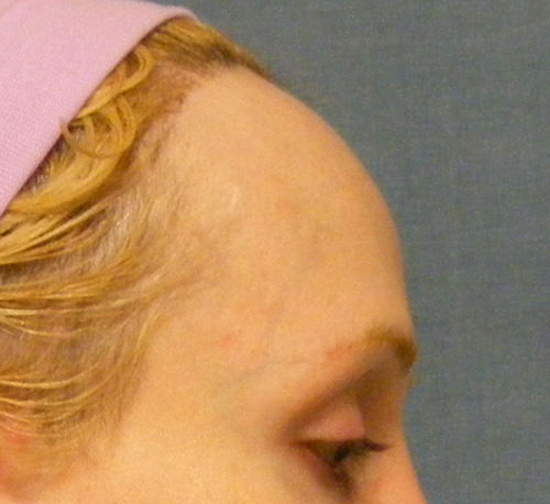 Hair Line Lowering