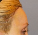 Hair Line Lowering